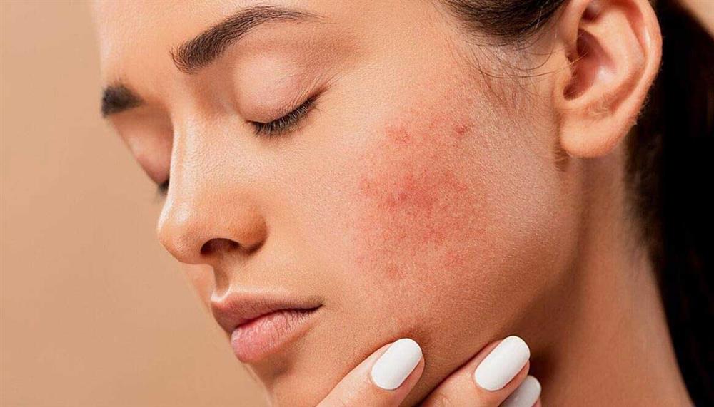 rosacea